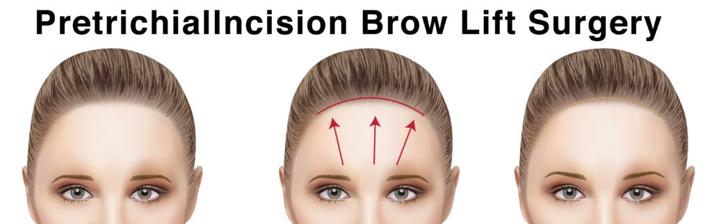 การศัลยกรรมยกคิ้วด้วยเทคนิค Pretrichial Incision Brow Lift​