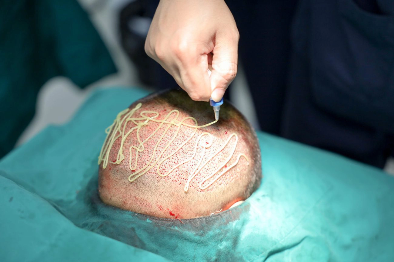 FUE Hair Implant Micro และย้ายรากผม