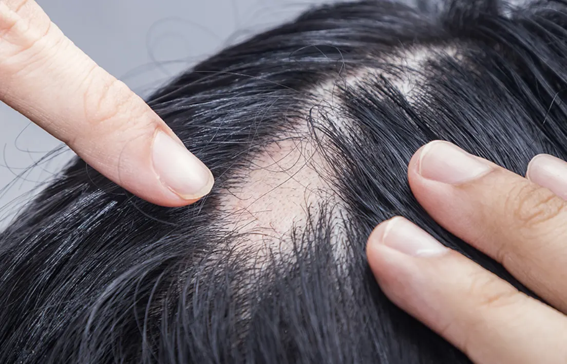 ศัลยกรรมปลูกผม__Facebody Clinic