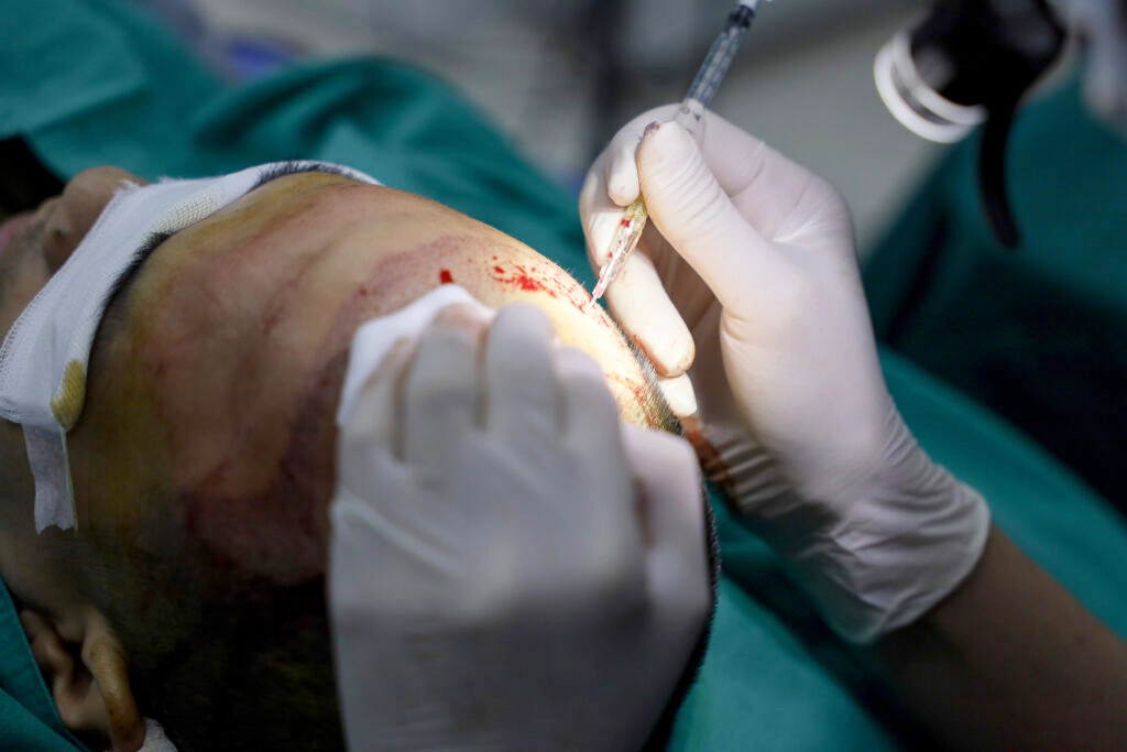 เริ่มขั้นตอนในการปลูกผม A