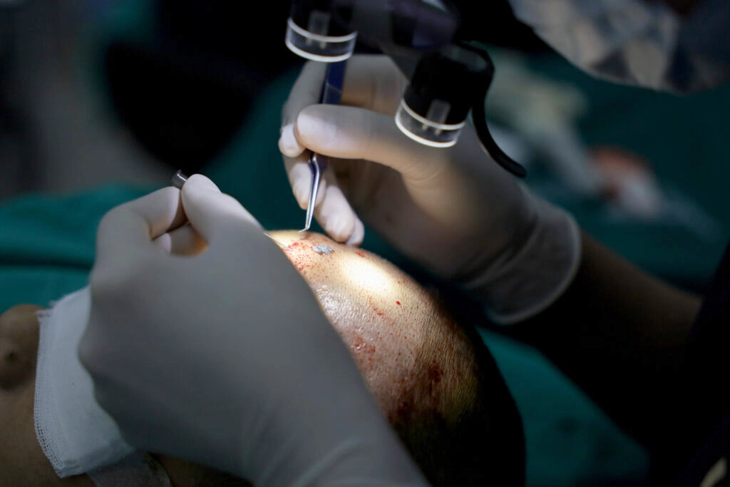 เริ่มขั้นตอนในการปลูกผม B