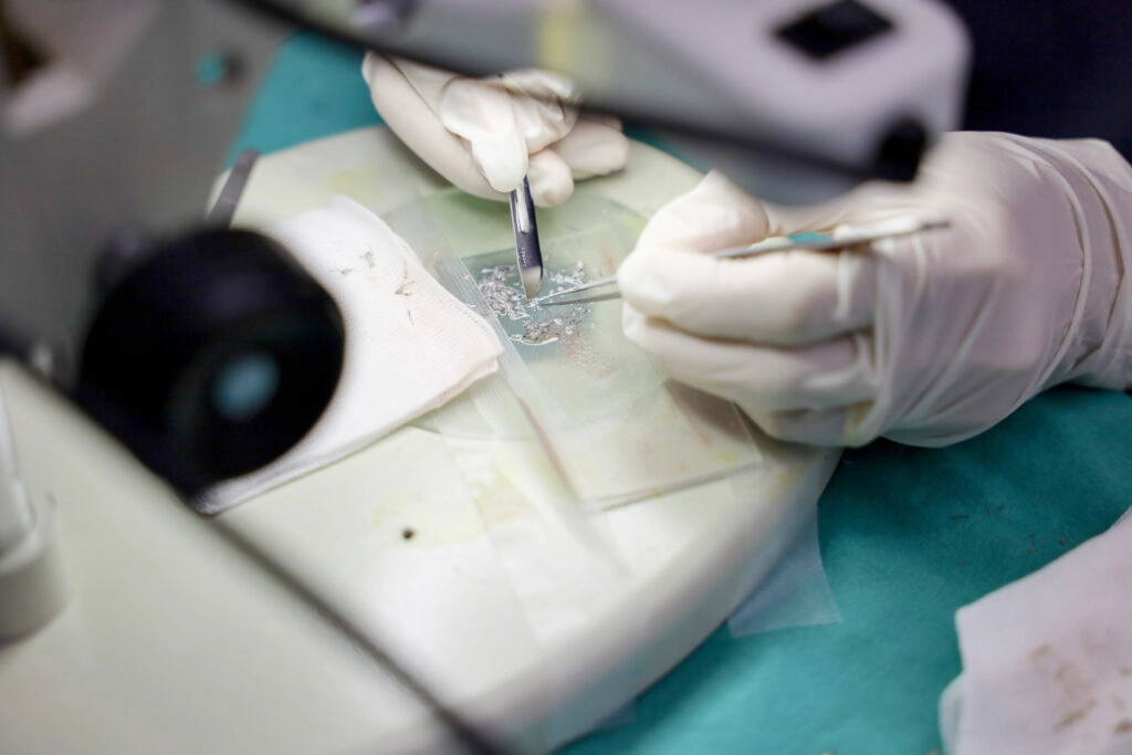 แพทย์และทีมจะทำการแยกรากออกจากกัน