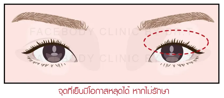 ทำตาสองชั้น แก้ปัญหาตาตก ชั้นตาไม่เท่ากัน ชั้นตาหลบใน กล้ามเนื้อตาอ่อนแรง ตาปรือ ตาลอย ตาชั้นเดียว ให้มีชั้นตาที่สวยเข้ากับใบหน้า โดยจักษุแพทย์ และทีมแพทย์