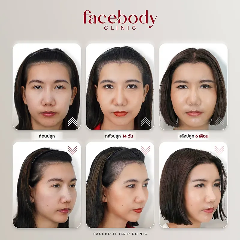 ปลูกผมผู้หญิง ตอบชัดๆ ผู้หญิงปลูกผมได้ไหม​