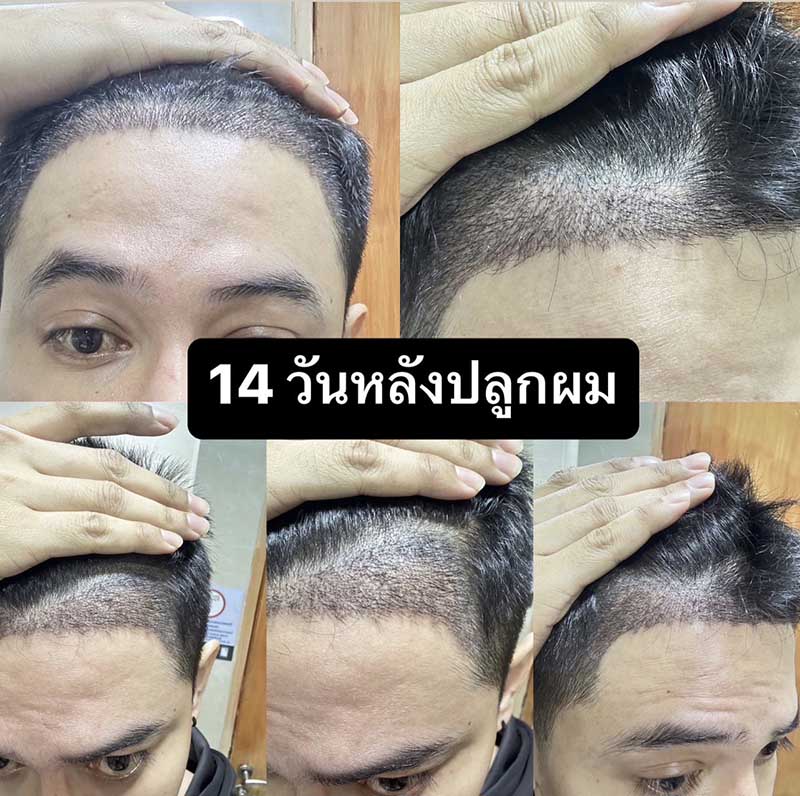 รีวิวปลูกผม 14 วัน คุณโอ๊ต Facebody Clinic วันที่ 14