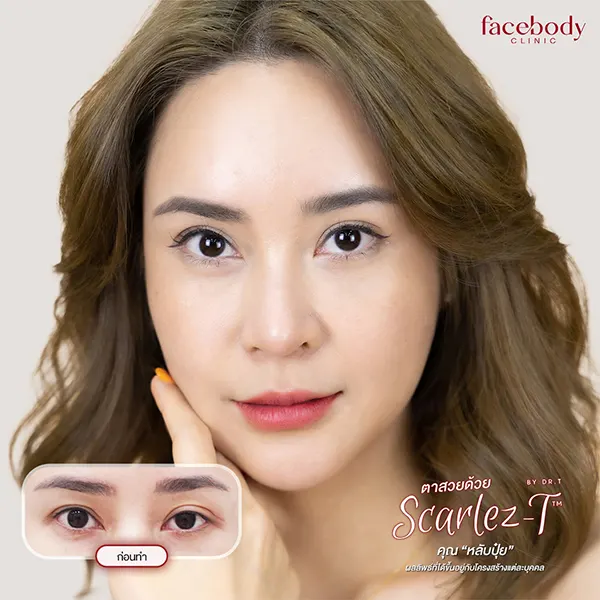 รีวิวทำตาสองชั้น - คุณทะเลทราย