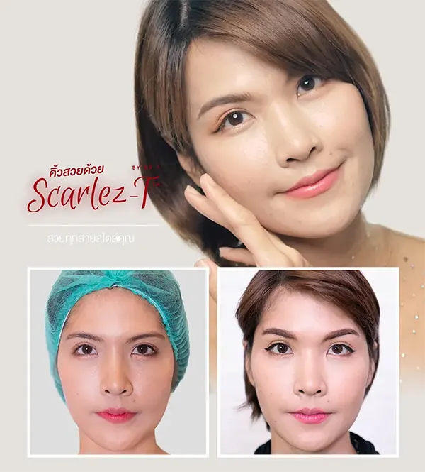 ยกคิ้ว ศัลยกรรม แก้ปัญหา คิ้วตก ตาตก