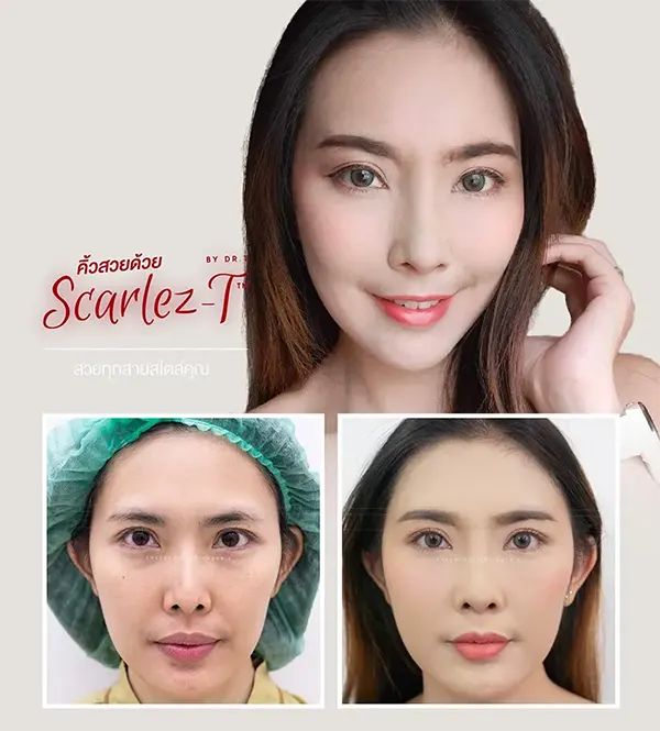 ยกคิ้ว ศัลยกรรม แก้ปัญหา คิ้วตก ตาตก