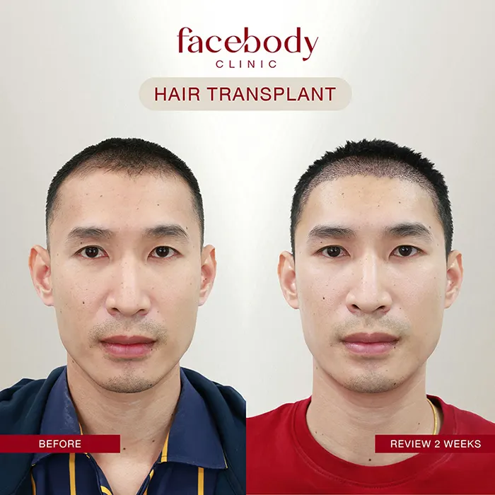 ปลูกผมชาย (1)