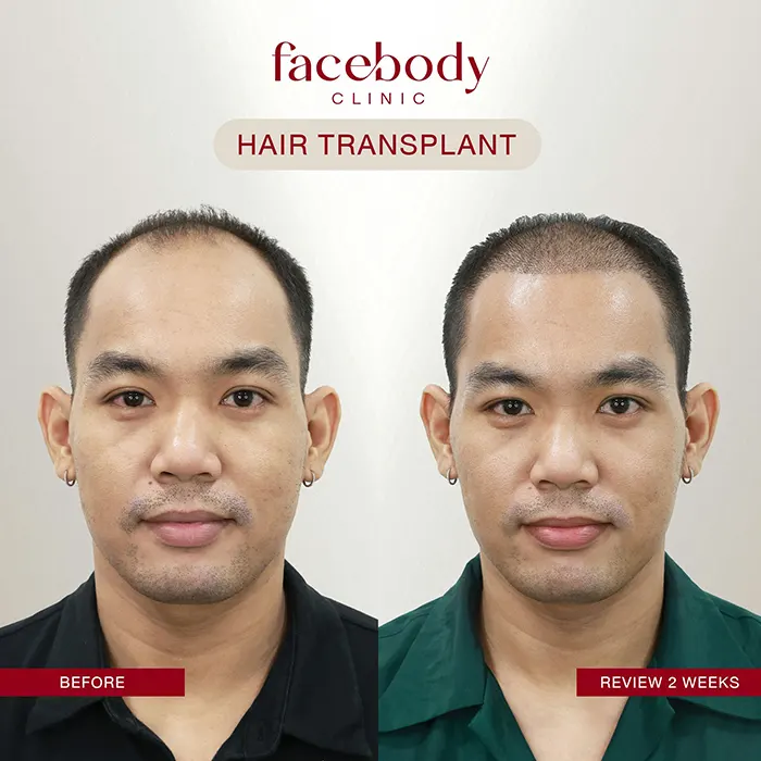 ปลูกผมชาย (10)