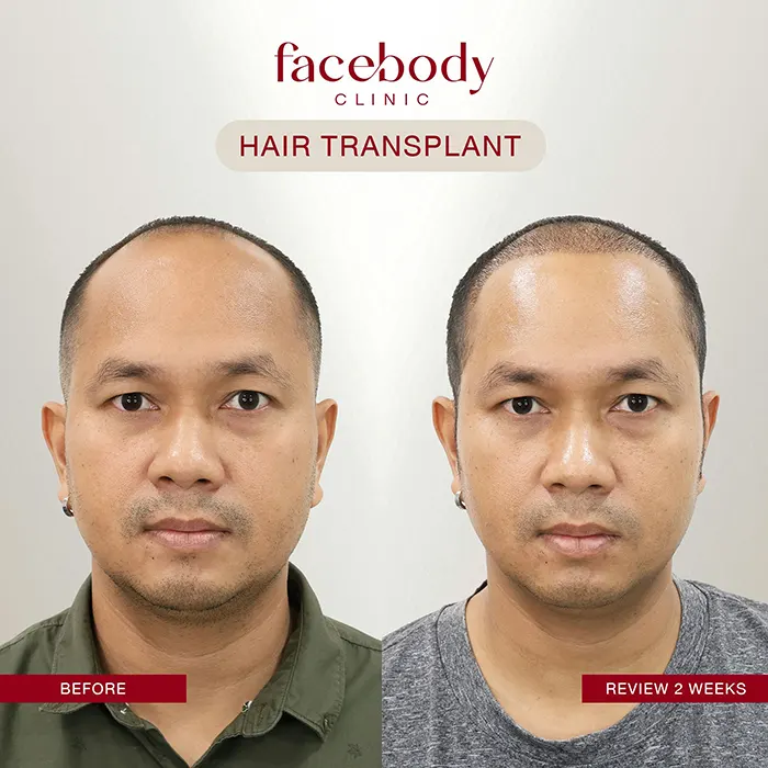 ปลูกผมชาย (11)