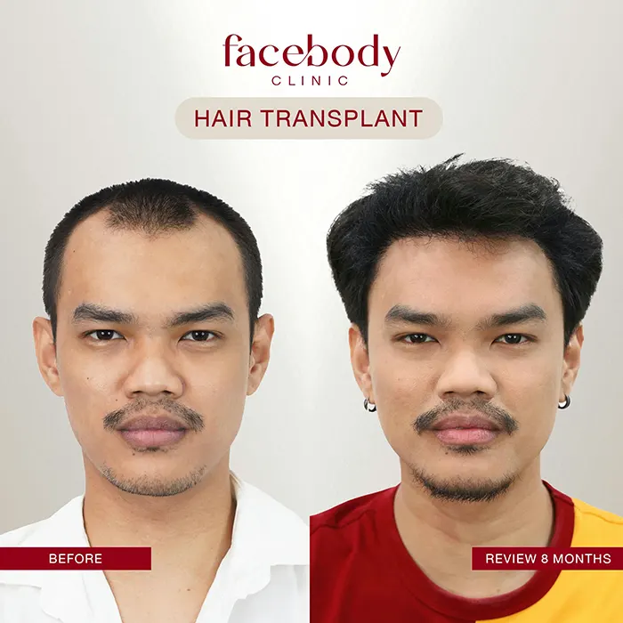 ปลูกผมชาย (12)