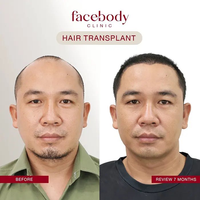 ปลูกผมชาย (2)