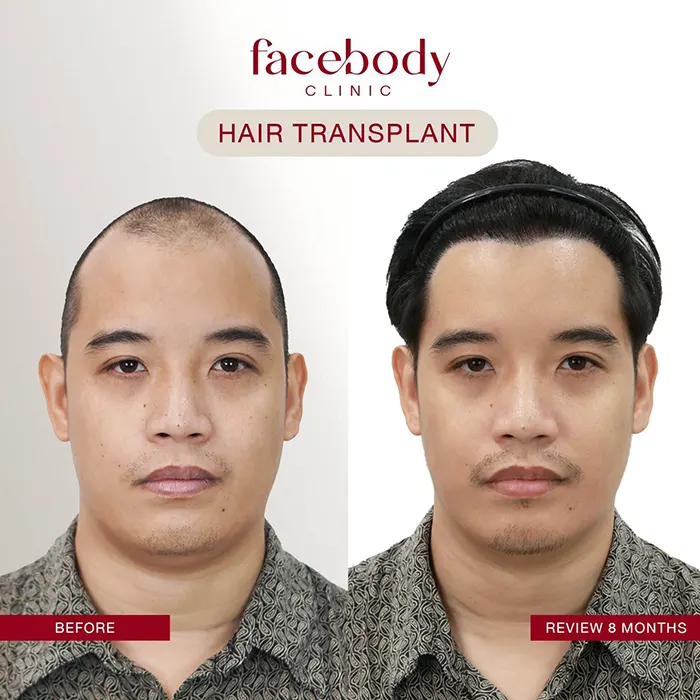 ปลูกผมชาย (3)