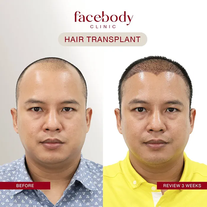 ปลูกผมชาย (4)