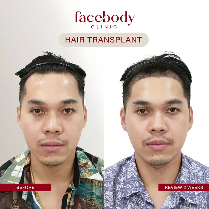 ปลูกผมชาย (5)