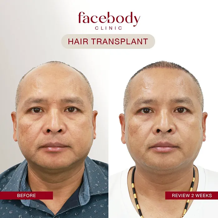 ปลูกผมชาย (6)