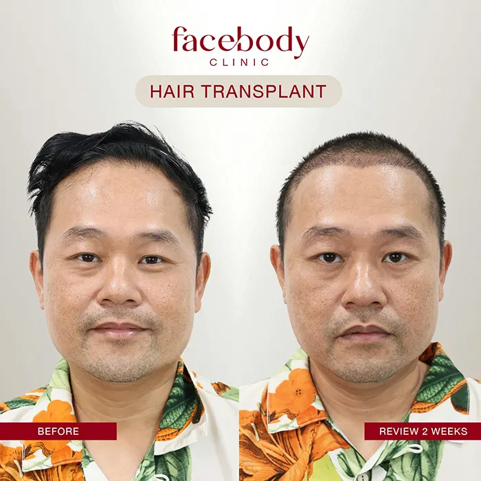 ปลูกผมชาย (7)