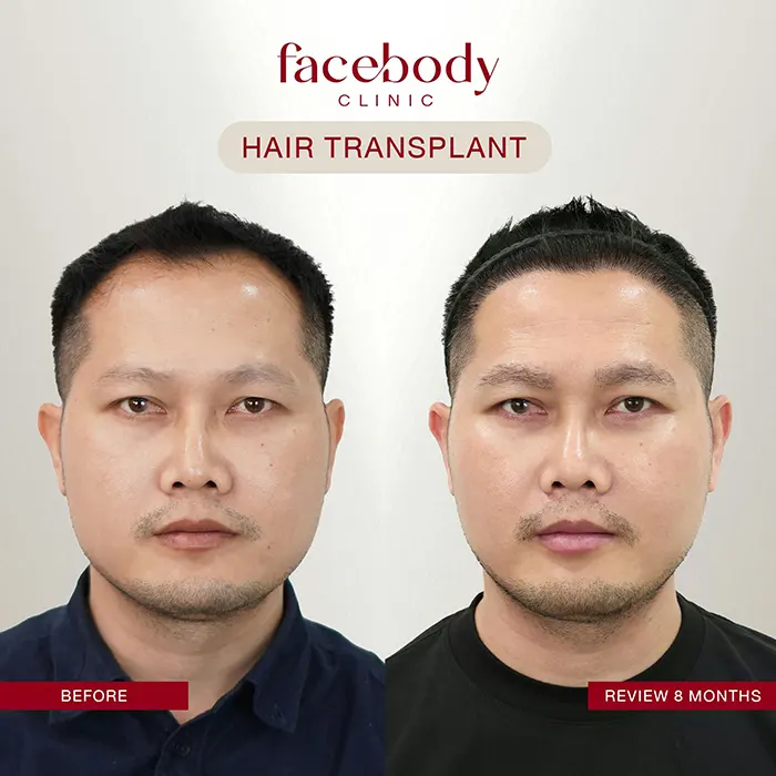 ปลูกผมชาย (8)