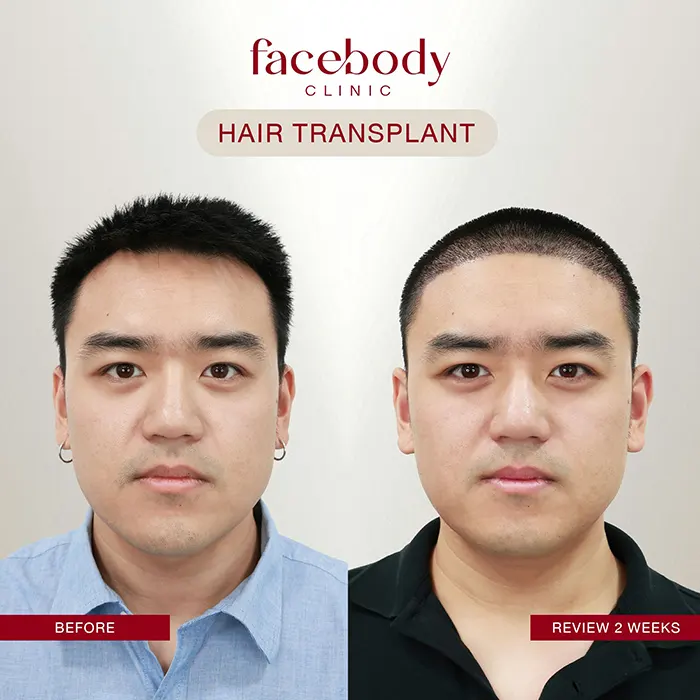 ปลูกผมชาย (9)