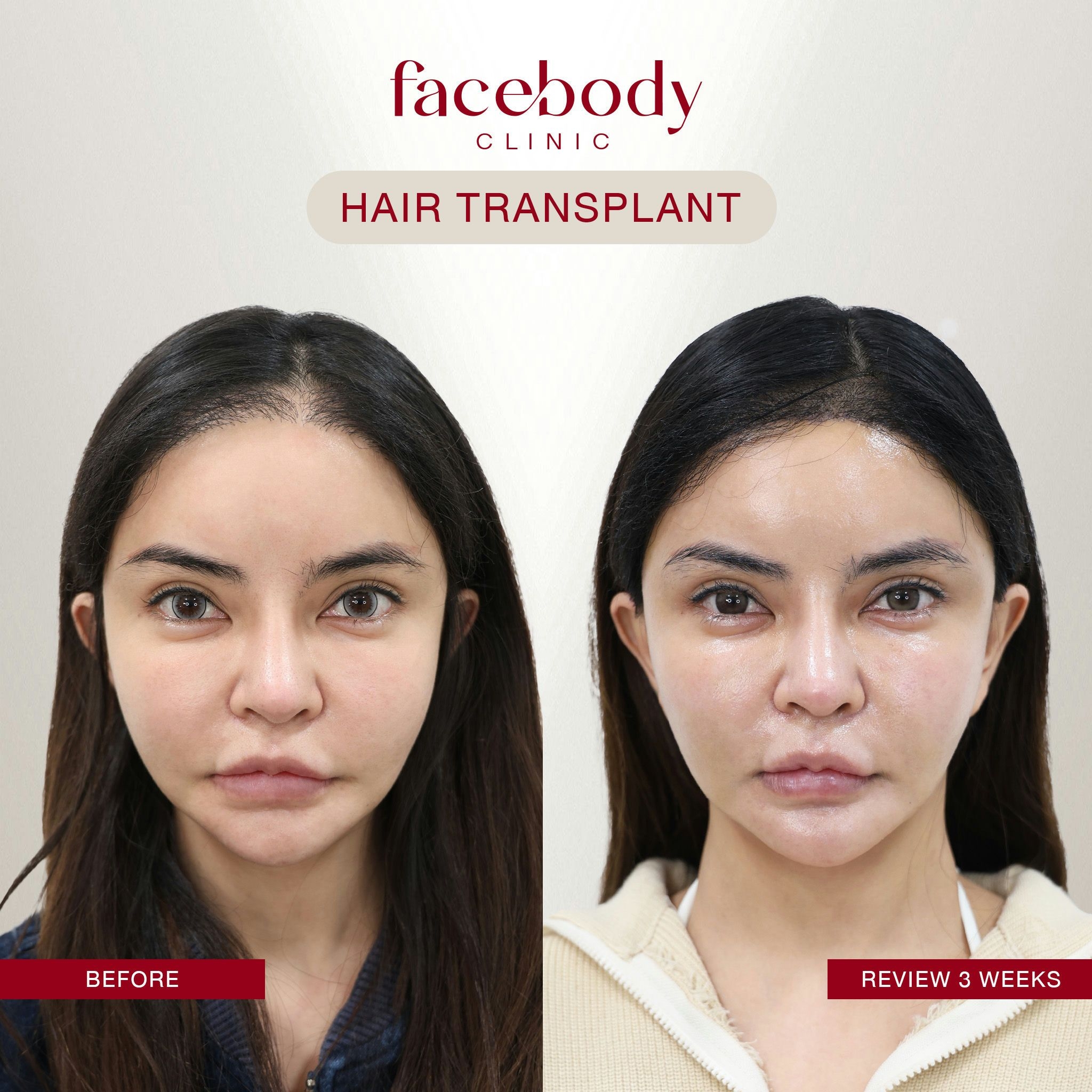 ผู้หญิง-ปลูกผม (13)