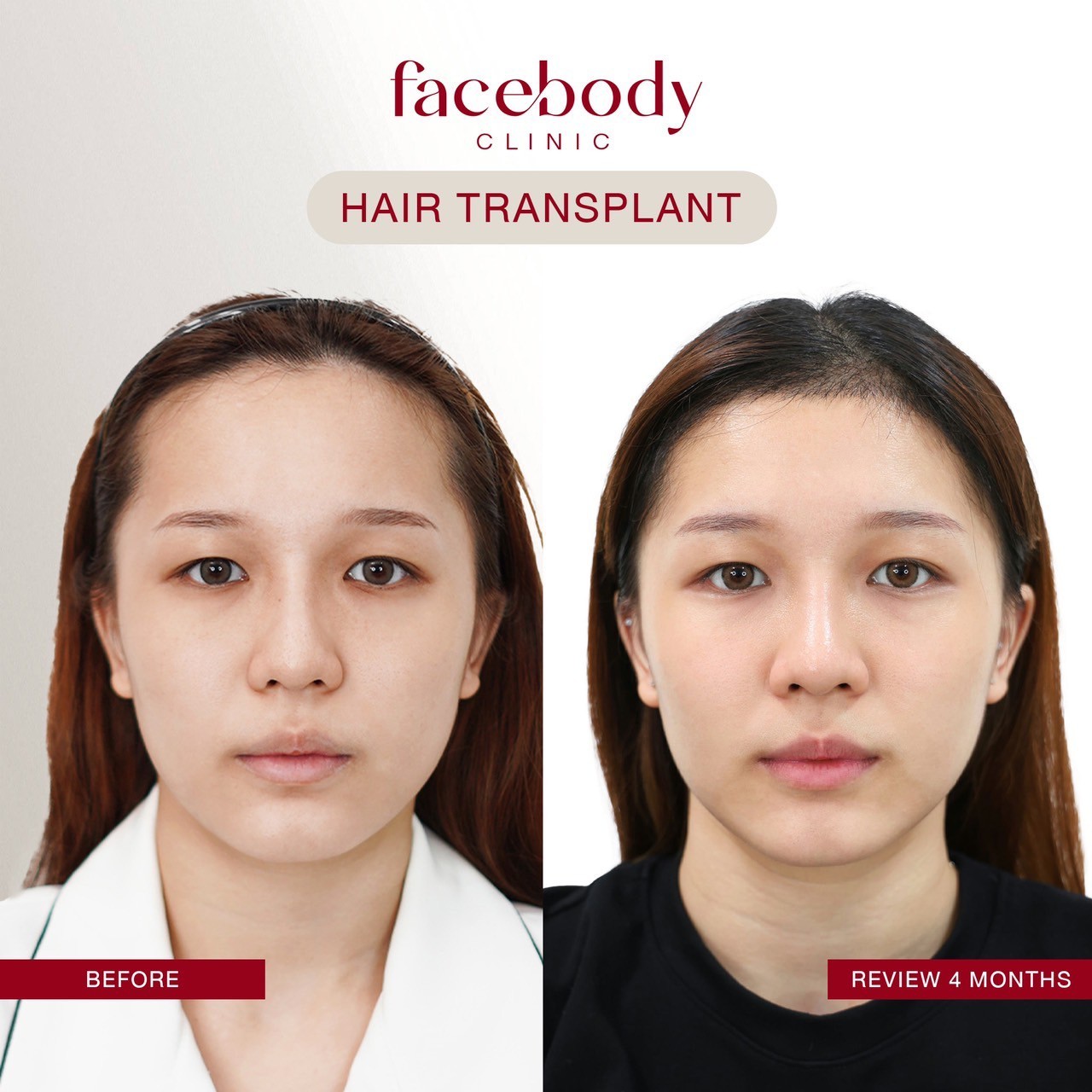 ผู้หญิง-ปลูกผม (5)