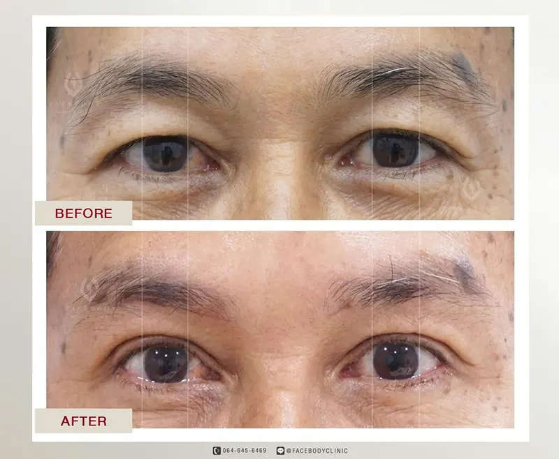 ทำตาสองชั้น ราคา