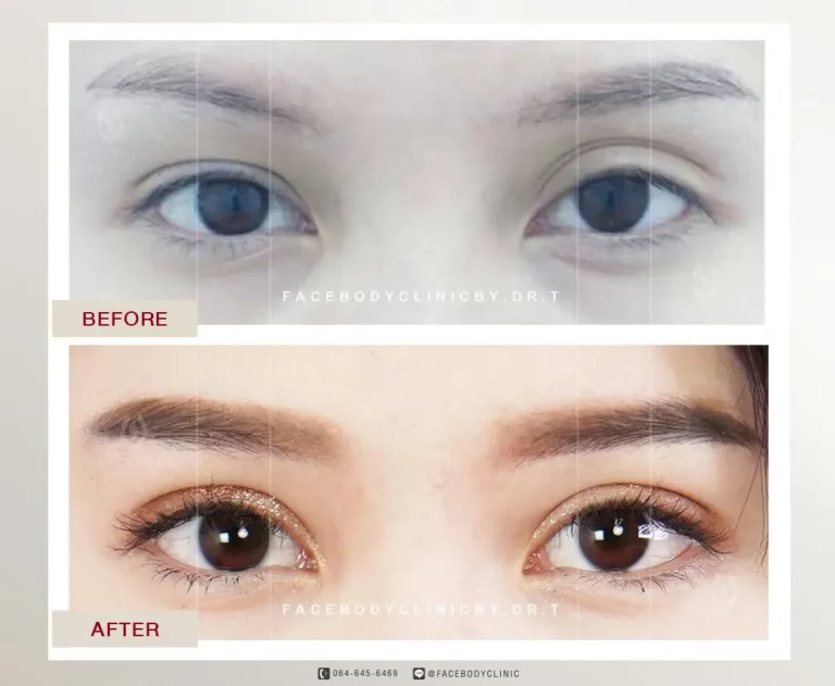 ทำตาสองชั้นราคา ทำตาสองชั้นที่ไหนดี ราคาต่างกันไหม