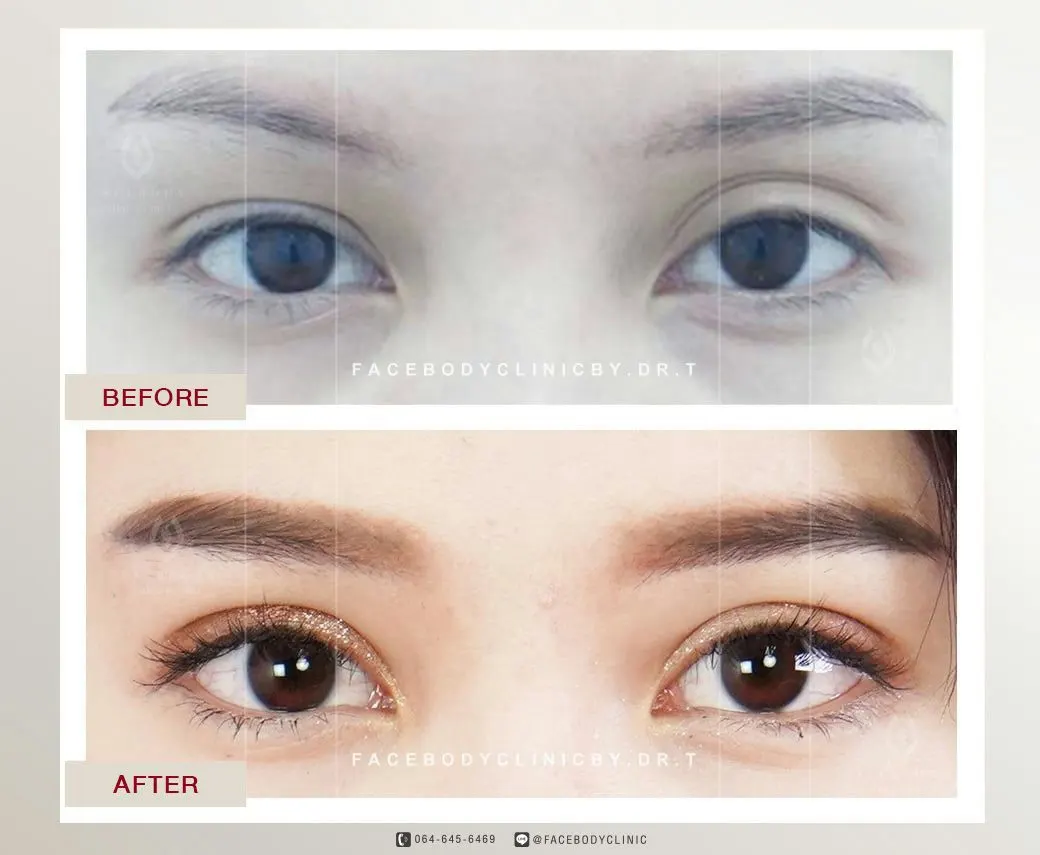 ทำตาสองชั้นราคา ทำตาสองชั้นที่ไหนดี ราคาต่างกันไหม