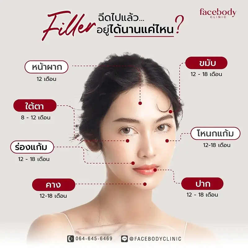 ฟิลเลอร์ filler ฉีดที่ใดได้บ้าง