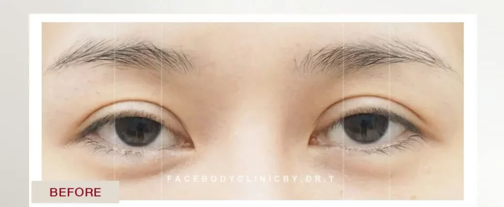 กล้ามเนื้อตาอ่อนแรง-FACEBODY CLINIC