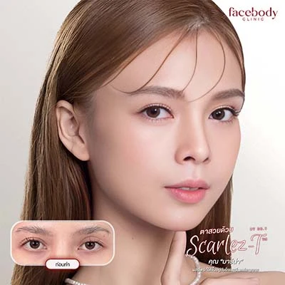 ทำตาสองชั้น ปลูกผม ยกคิ้ว ฟิลเลอร์