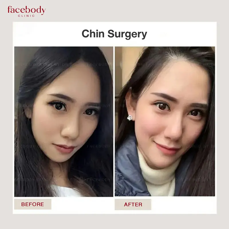 เสริมคาง facebodyclinic