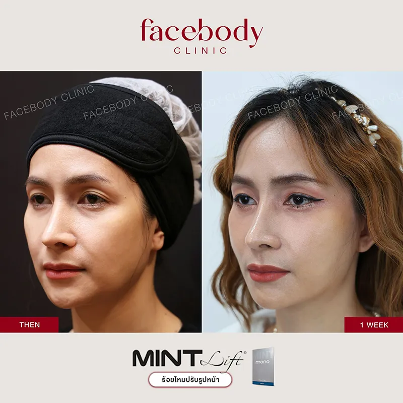 ร้อยไหม ยกกระชับทันใจ เห็นผลทันที