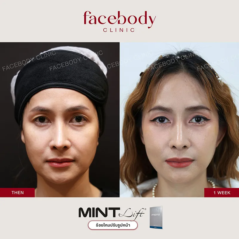 ไหมละลายและไหมไม่ละลาย ต่างกันอย่างไร ไหมละลายและไหมไม่ละลาย ต่างกันอย่างไร