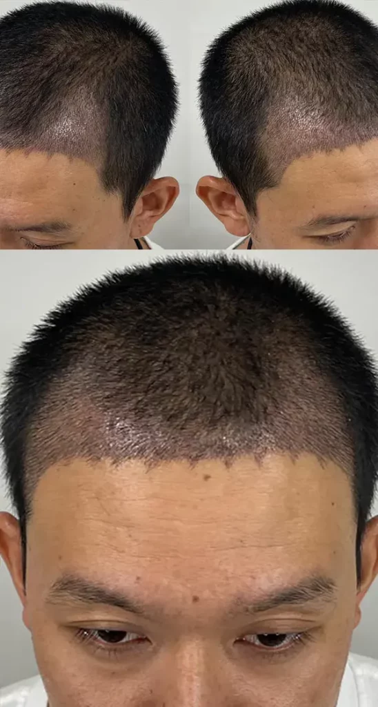 รีวิวปลูกผมถาวร หลังจากอดทนกับ M เว้า 7 ปี