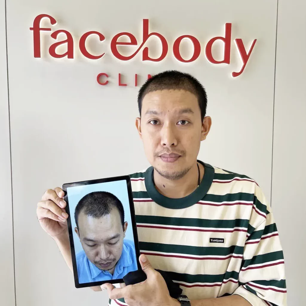 รีวิวปลูกผมถาวร หลังจากอดทนกับ M เว้า 7 ปี