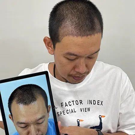 รีวิวปลูกผมถาวร หลังจากอดทนกับ M เว้า 7 ปี