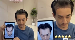 ปลูกผม facebody