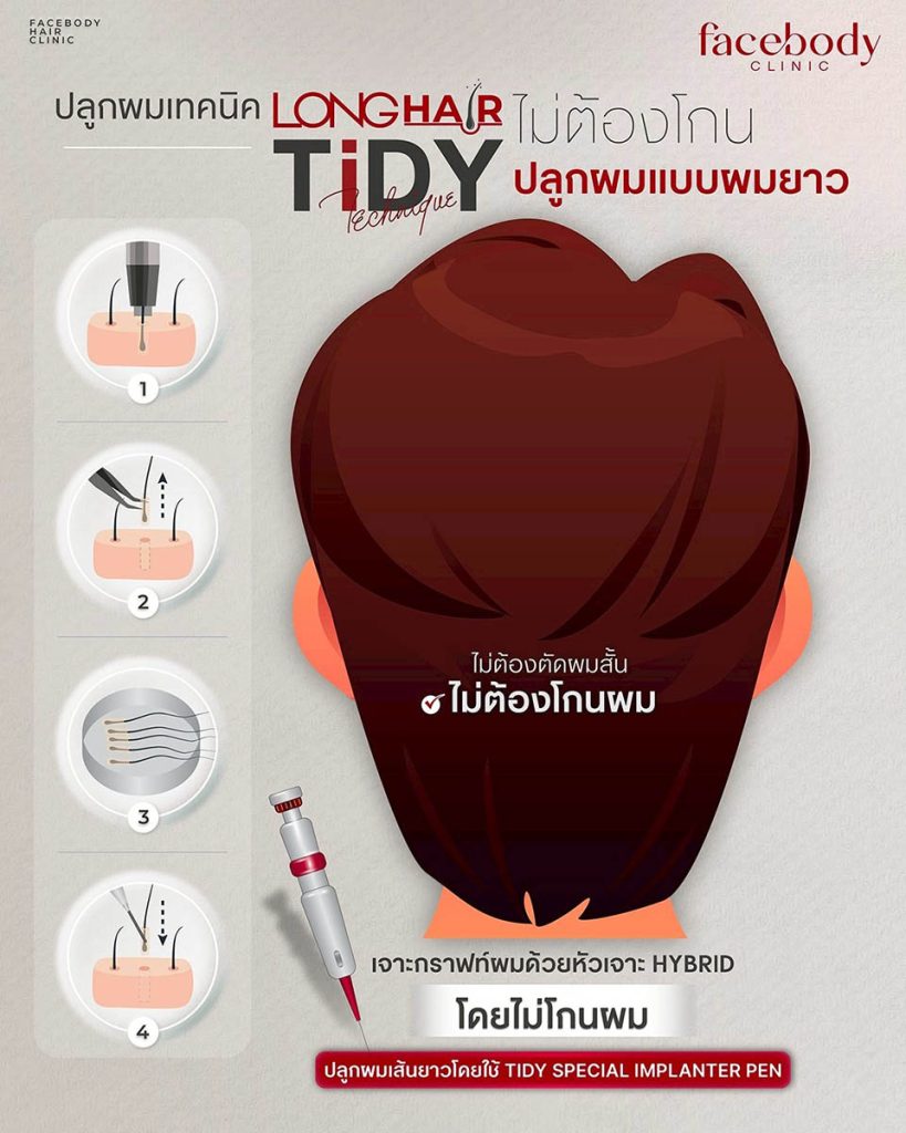 เทคนิคปลูกผมทำให้สามารถใช้ชีวิตประจำวันได้ปกติ โดยขั้นตอนในการปลูกแบบ TiDY Non-Shaved จะคล้ายกับการปลูกผมเทคนิคแบบ LONGHAIR แต่จะมีขั้นตอนที่ละเอียดอ่อนและอุปกรณ์พิเศษในการเจาะกราฟท์ผมและขั้นตอนการปลูกผม และการวางแนวทิศทางผมที่ให้ความหนาแน่น เป็นธรรมชาติมากที่สุด