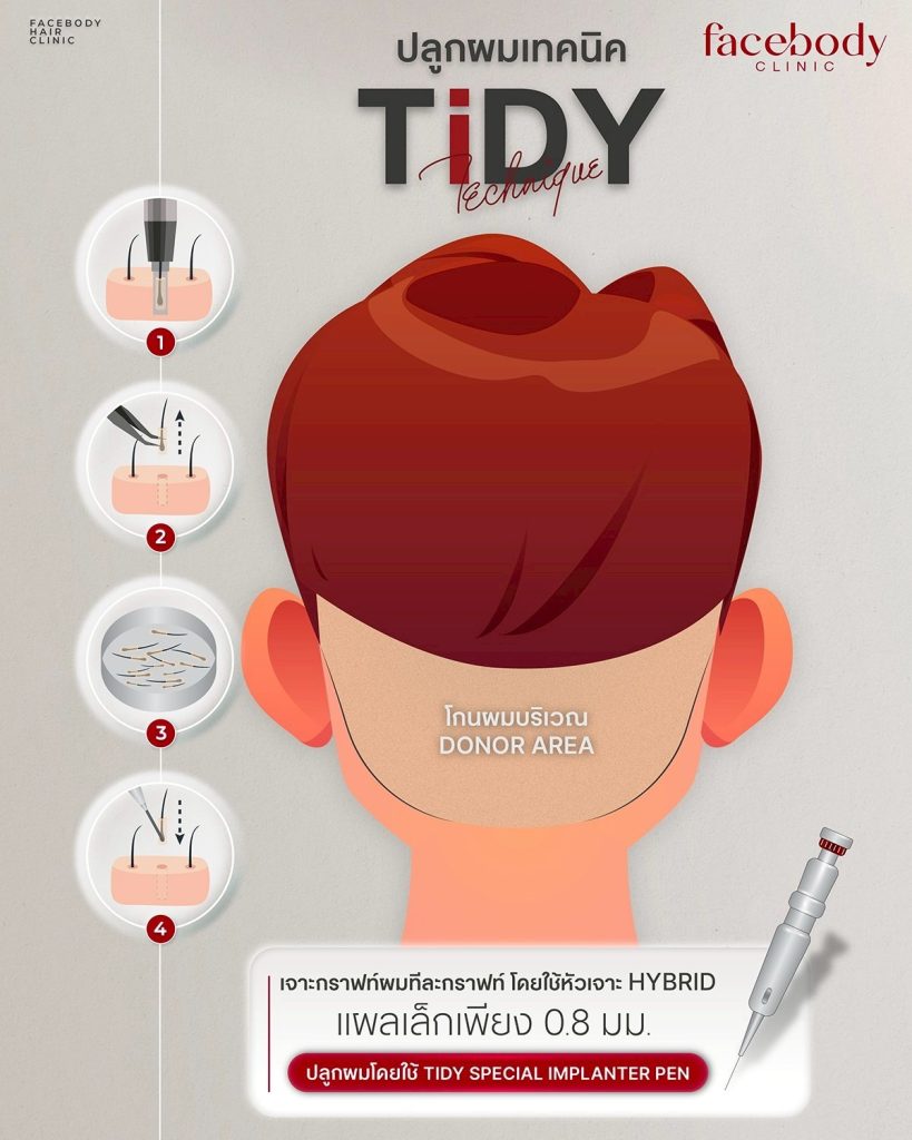 เป็นเทคนิคปลูกผมที่มีขั้นตอนและกระบวนการทำที่ใช้เวลามากขึ้นเล็กน้อยเมื่อเทียบจากเทคนิคอื่นๆ มีการใช้หัวเจาะขนาดเล็กพิเศษนำเข้าจากต่างประเทศ ทำให้แผลหายไว พักฟื้นสั้น มีความปลอดภัยสูง เพิ่มประสิทธิภาพและความหนาแน่นของการปลูกผมได้อย่างดีเยี่ยม ด้วยอุปกรณ์ใส่รากผมที่ถูกออกแบบเฉพาะ ร่วมกับการออกแบบแนวไรผม กรอบหน้า ทิศทางเส้นผมให้เป็นธรรมชาติและมีความหนาแน่นมากยิ่งขึ้น และเหมาะสมสำหรับแต่ละบุคคล