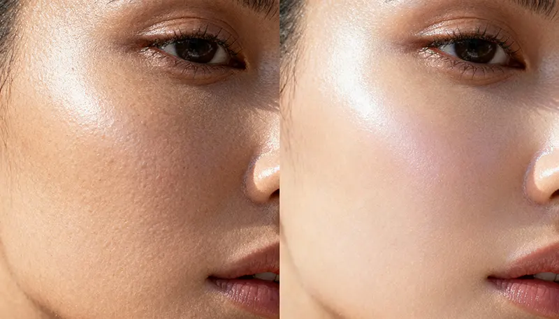 ภาพเปรียบเทียบผิวที่ขาดน้ำกับผิวที่ได้รับการฉีด SKIN Booster จนอิ่มน้ำและดูสุขภาพดี ภาพเปรียบเทียบผิวที่ขาดน้ำกับผิวที่ได้รับการฉีด SKIN Booster จนอิ่มน้ำและดูสุขภาพดี