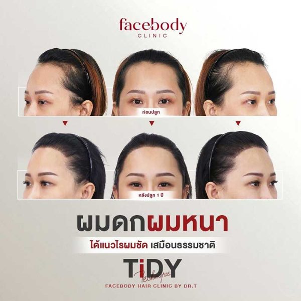 LINE_ALBUM_HAIR BA ผู้หญิง-(ปลูกผม คิ้ว)_241103_2