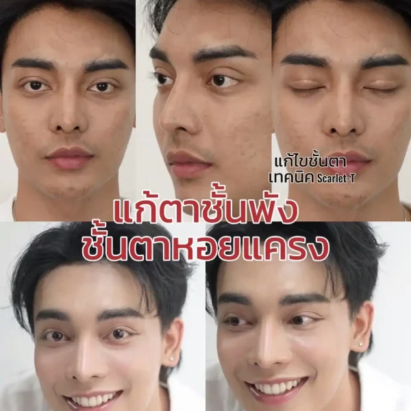 แก้ไขตาสองชั้น น้องสนุ๊กแชร์ประสบการณ์ตรงกับปัญหากล้ามเนื้อตาอ่อนแรง ชั้นตาใหญ่เกินธรรมชาติ
