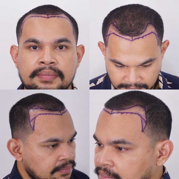 ปลูกผม คุณวายุ 3