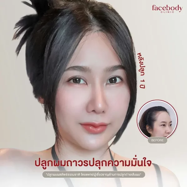 ปลูกผมผู้หญิง ตอบชัดๆ ผู้หญิงปลูกผมได้ไหม​