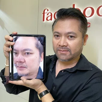 รีวิวปลูกผม (19)