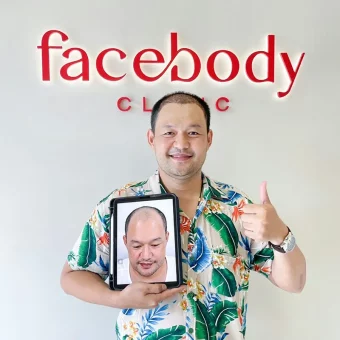 รีวิวปลูกผม (21)