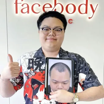 รีวิวปลูกผม (23)