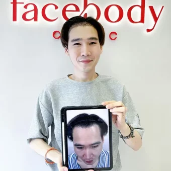 รีวิวปลูกผม (24)